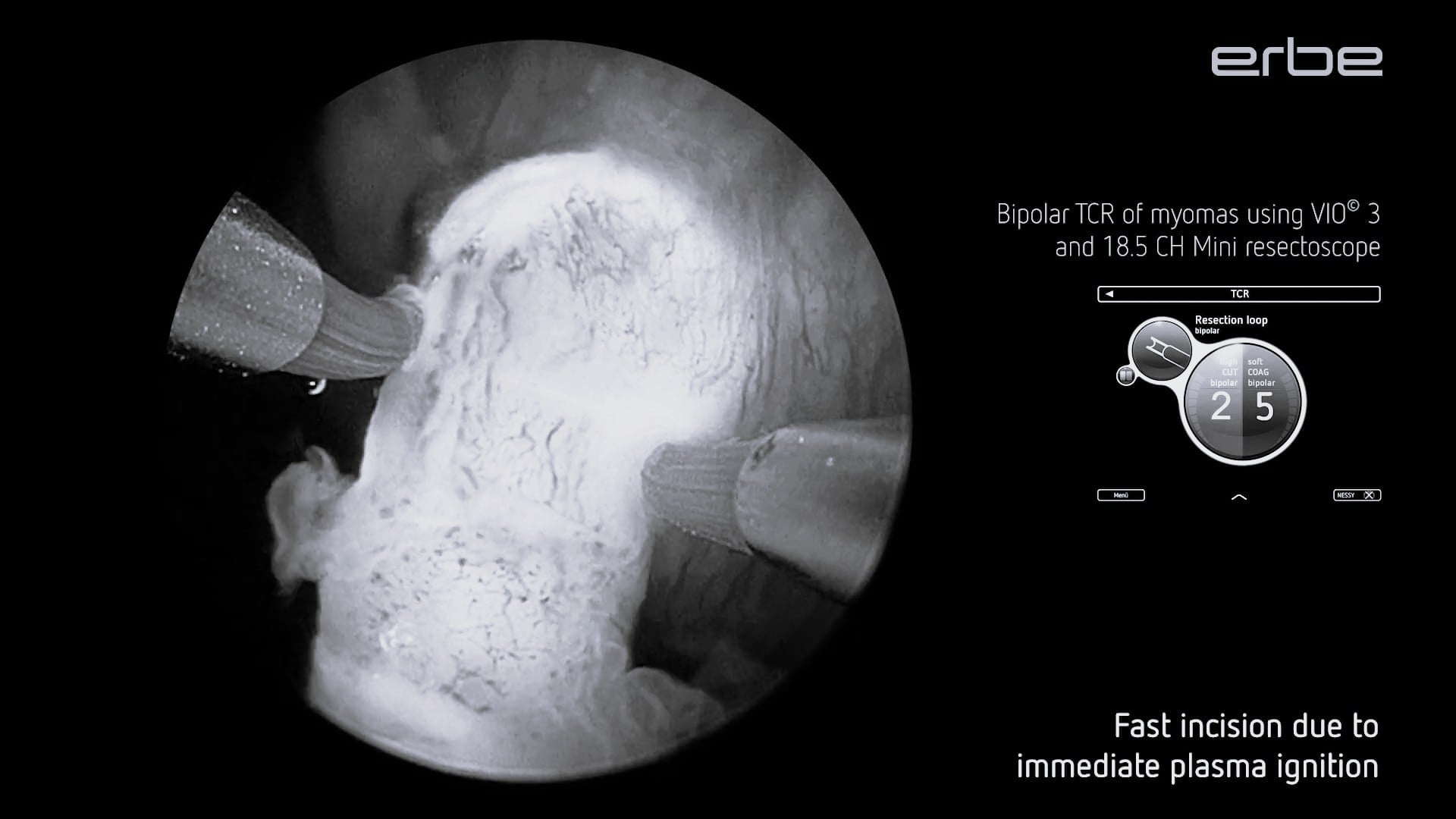 Bipolar transcervical resection (TCR) of myomas with VIO® 3 and 18.5 CH Mini resectoscope. Imaging with VIRON 1 System