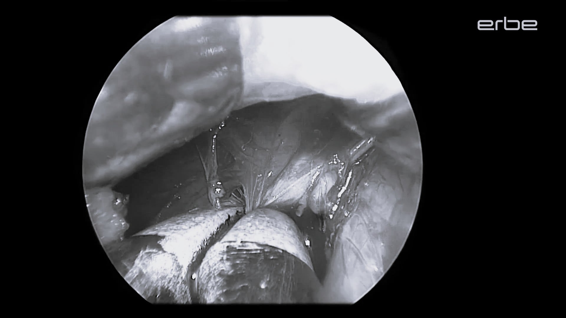 Minimally invasive thyroidectomy using BiClamp® 150 C