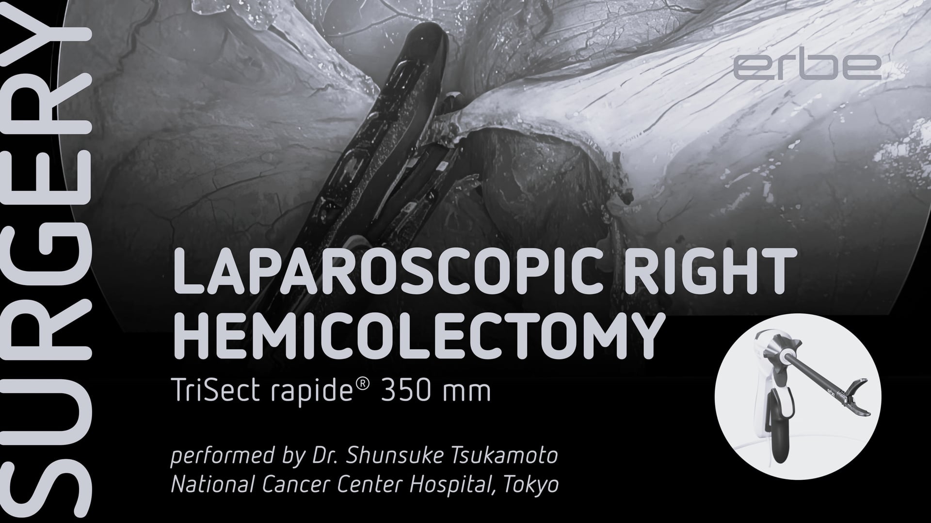 Laparoscopic right hemicolectomy with TriSect rapide® 350 mm