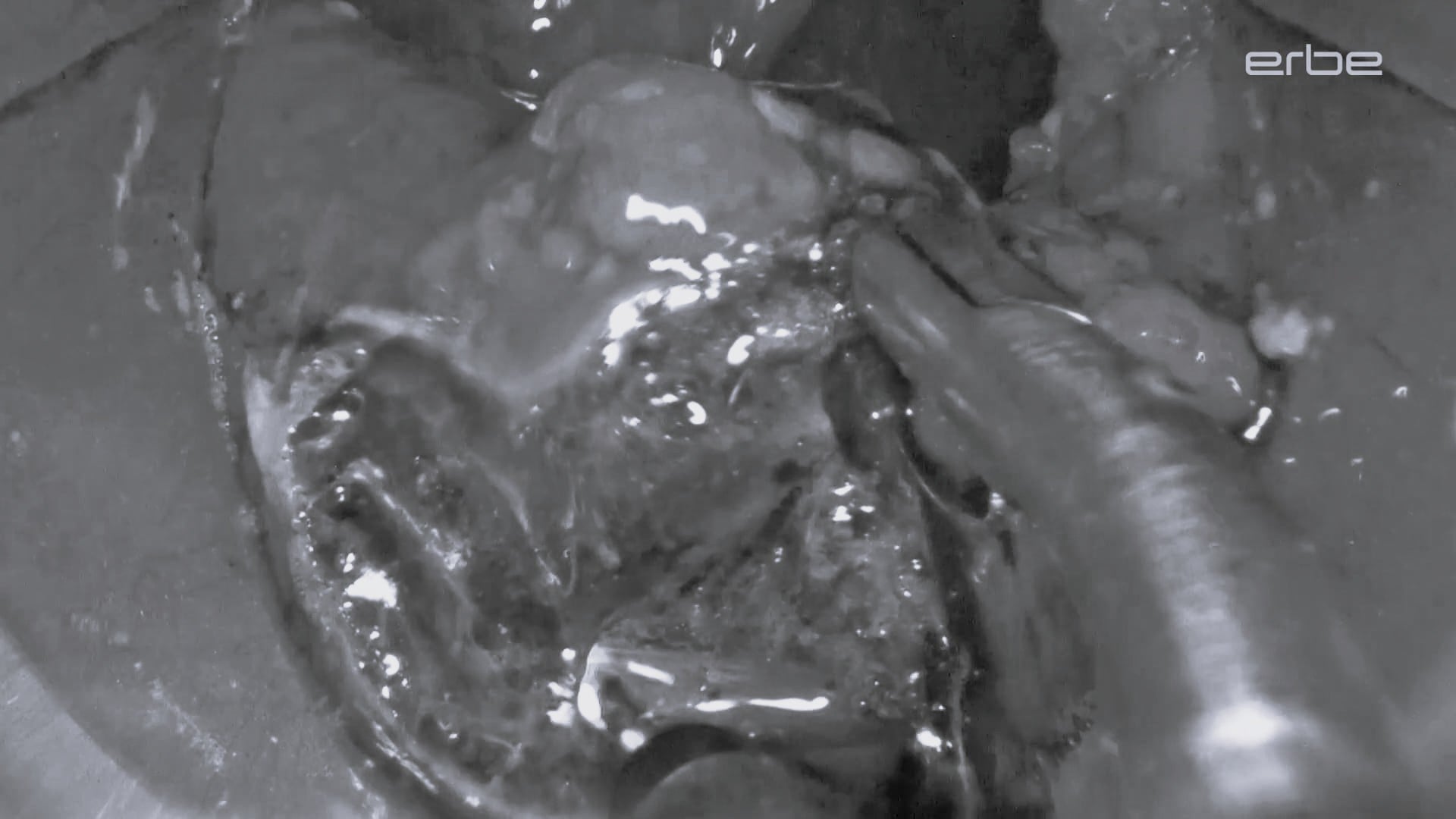 TEM-ESD using the preciseSECT VIO 3 mode