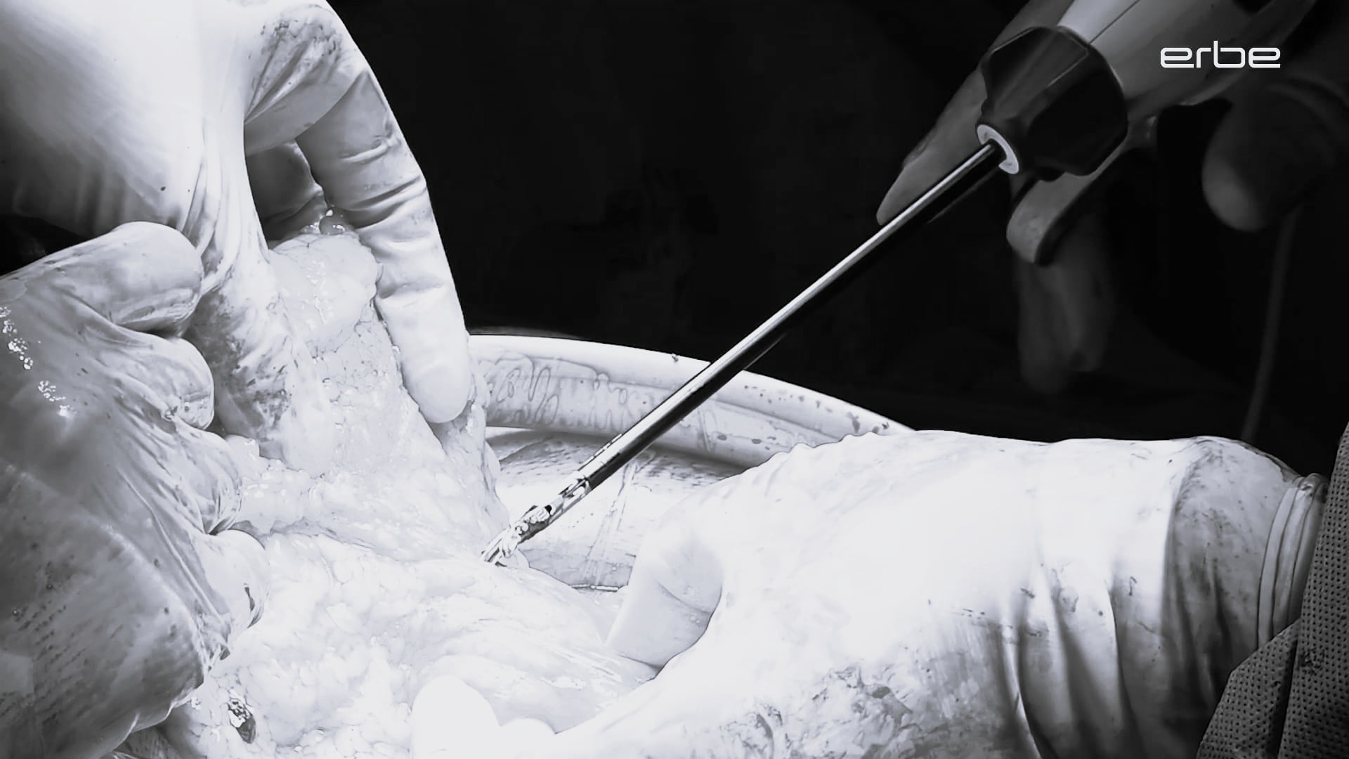 Open hemicolectomy with TriSect rapide® 140 and VIO® 3