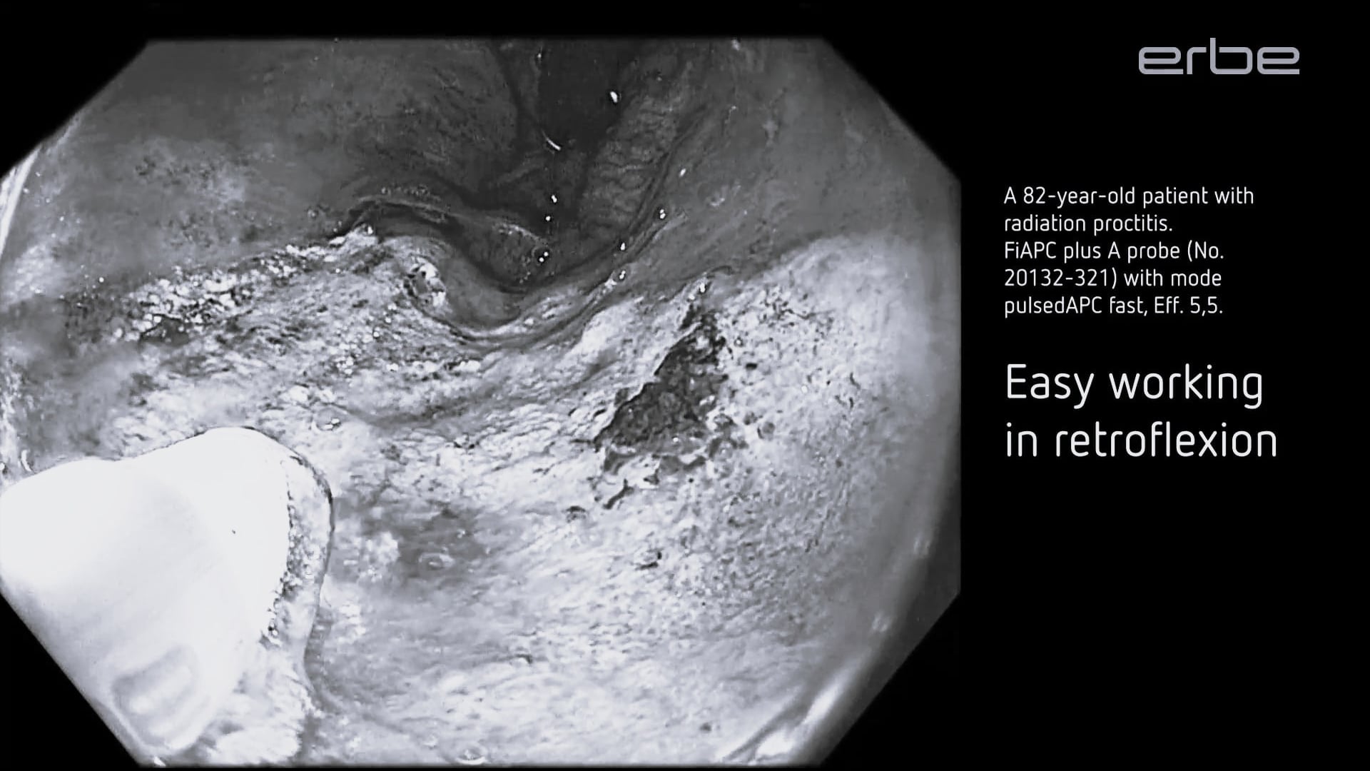 FiAPC plus A probe - easy working in retroflexion with pulsedAPC, fast, effect 5.5. / short