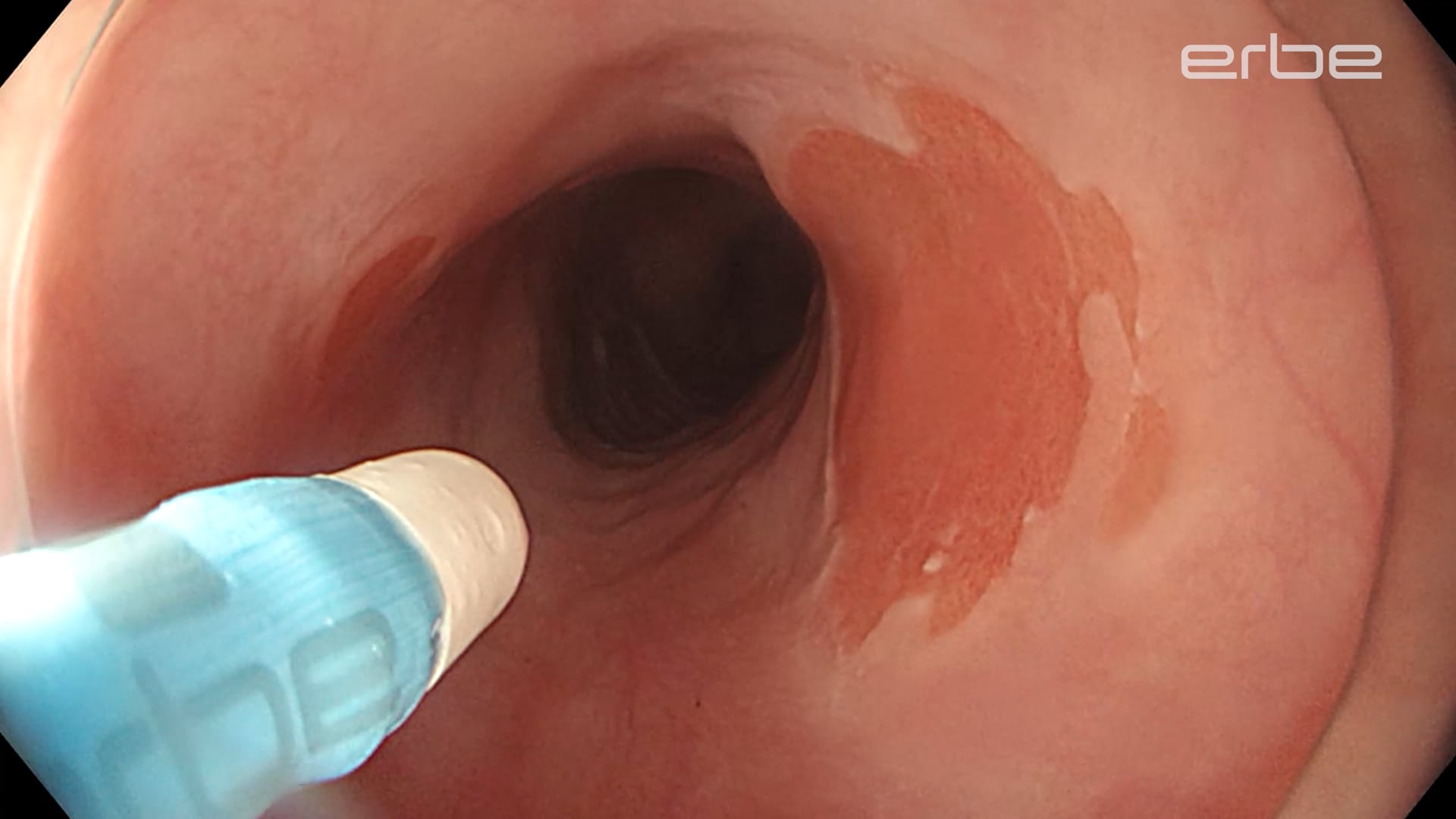 Heterotopic gastric mucosa - APC ablation using the FiAPC® plus probe with pulsedAPC® E3.5