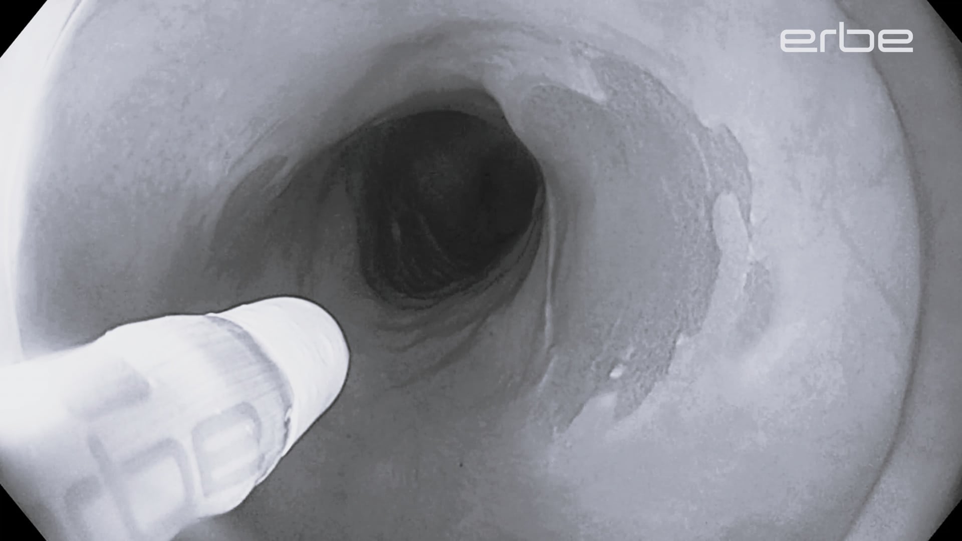 Heterotopic gastric mucosa - APC ablation using the FiAPC® plus probe with pulsedAPC® E3.5