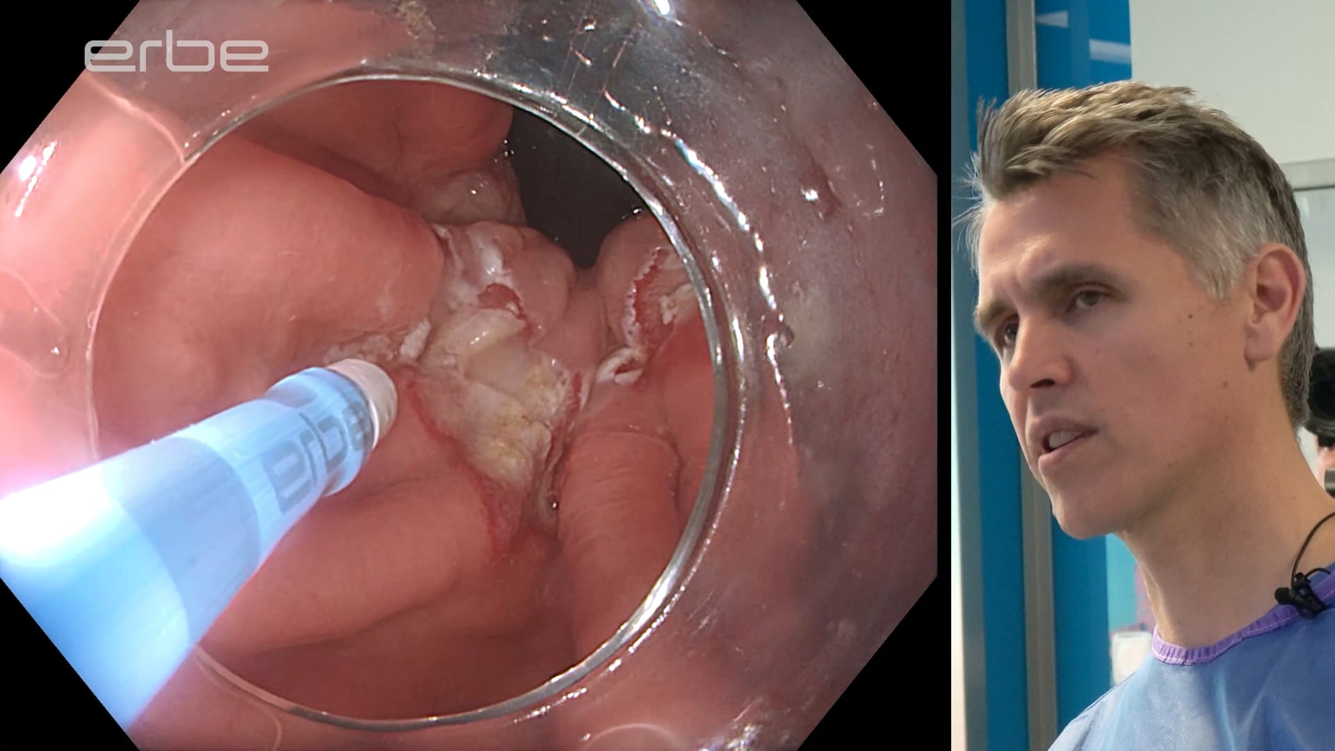 Residual Barrett´s mucosa - APC ablation using FiAPC® plus A probe (axial beam) with pulsedAPC®