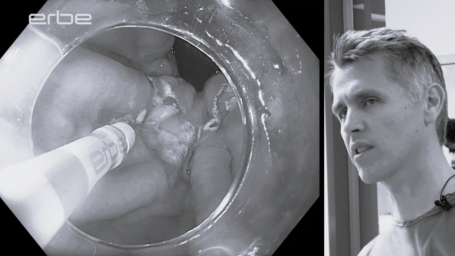 Residual Barrett´s mucosa - APC ablation using FiAPC® plus A probe (axial beam) with pulsedAPC®