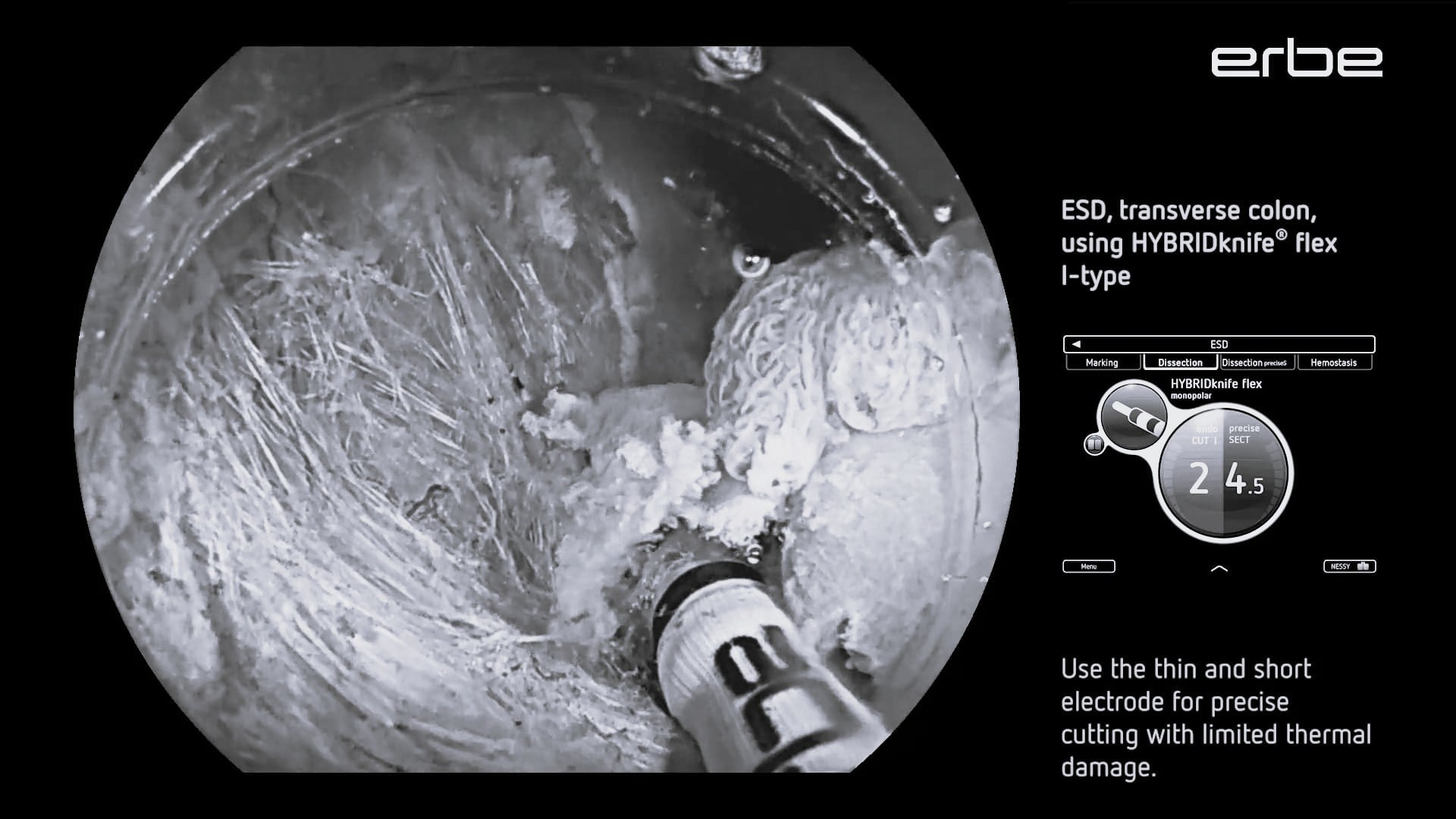 ESD, colon, splenic flexure, using HYBRIDknife® fIex, I-type