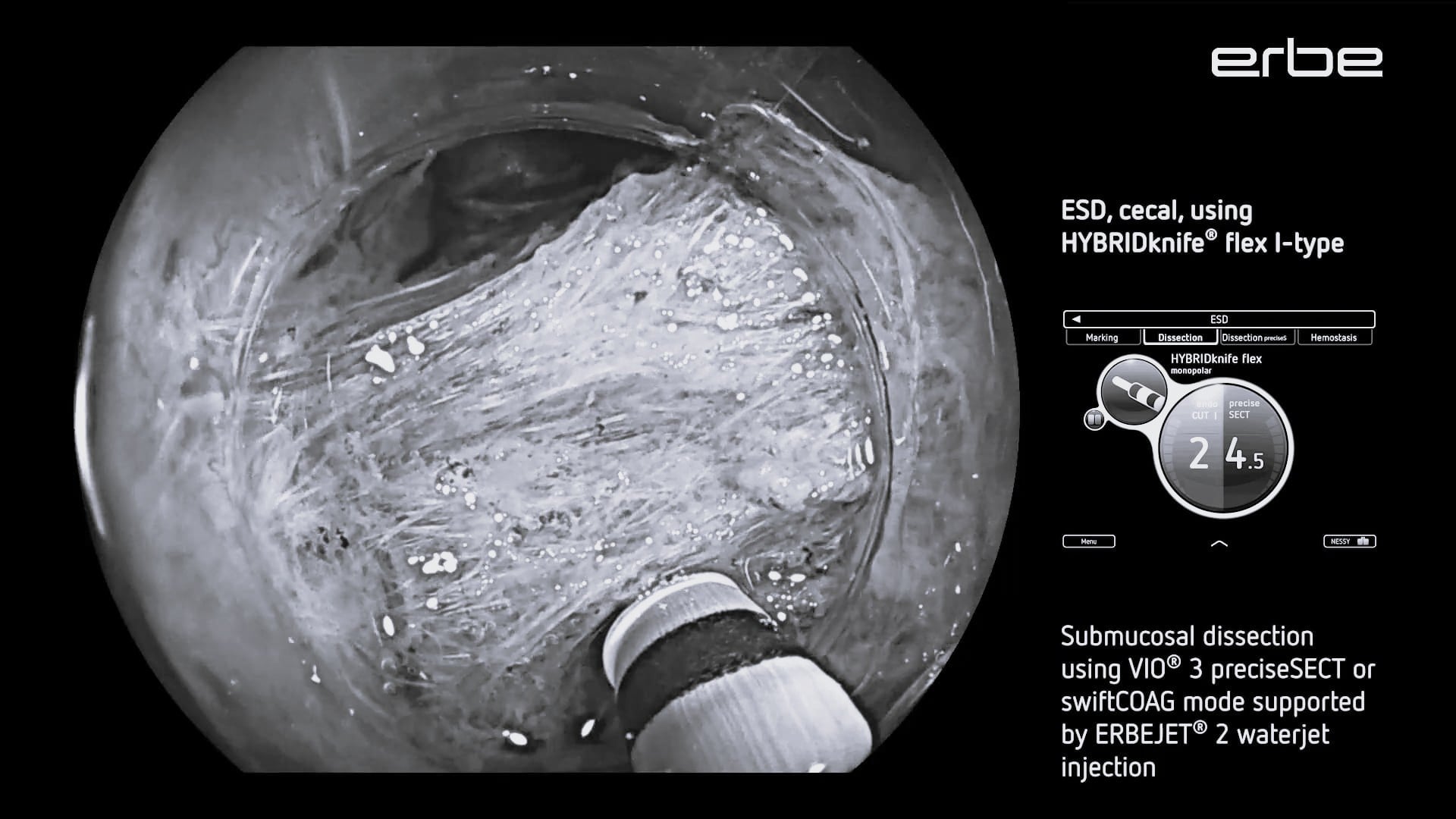 ESD, cecal, using HYBRIDknife® flex I-type