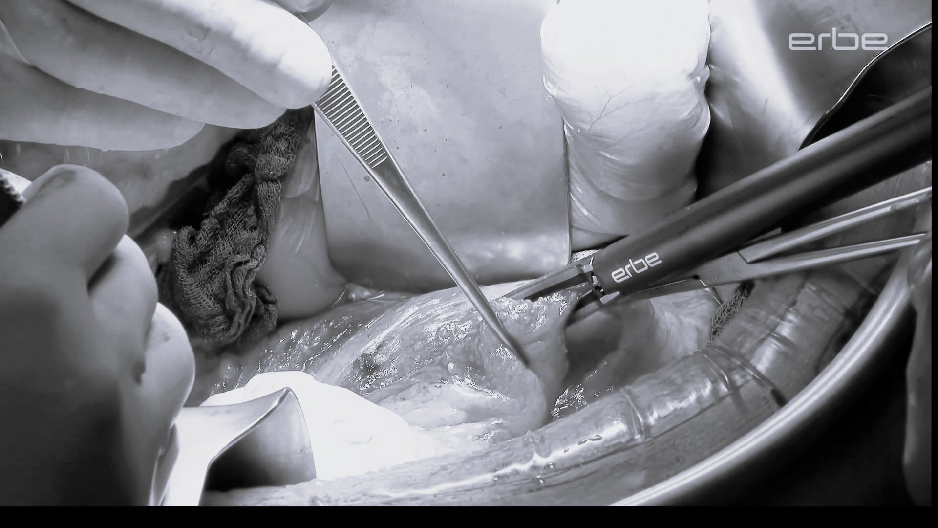 Multivisceral abdominal resection with BiClamp® knife 220