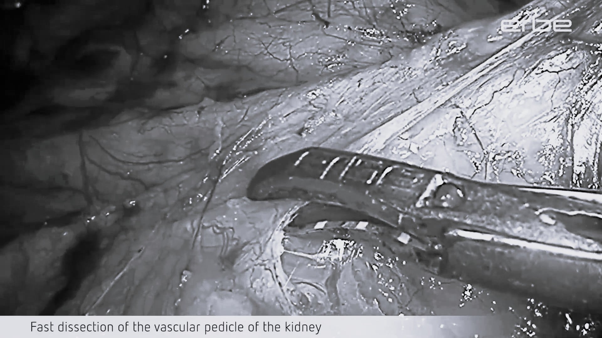 Laparoscopic donor nephrectomy using TriSect rapide® with VIRON X