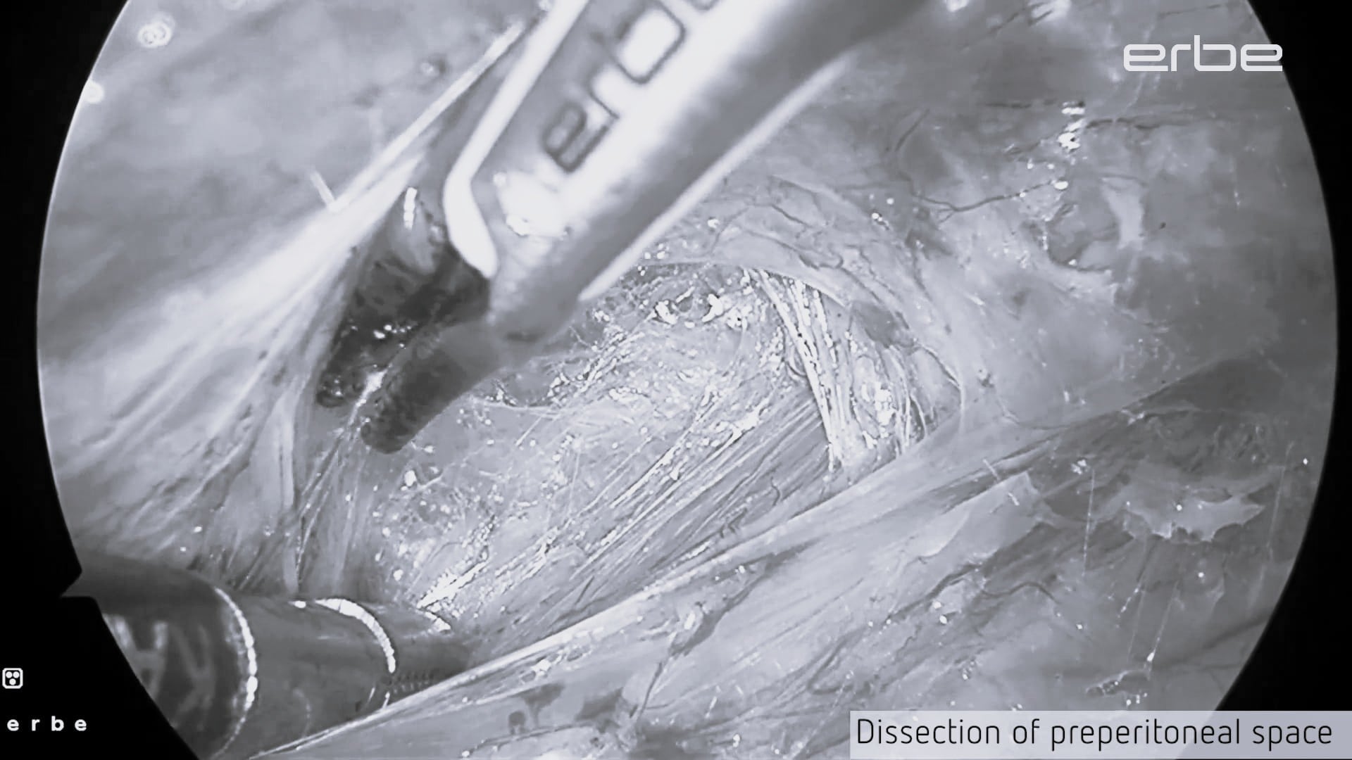 TEP inguinal hernia repair using LAP BiSect Micro, VIO® 3 and VIRON X