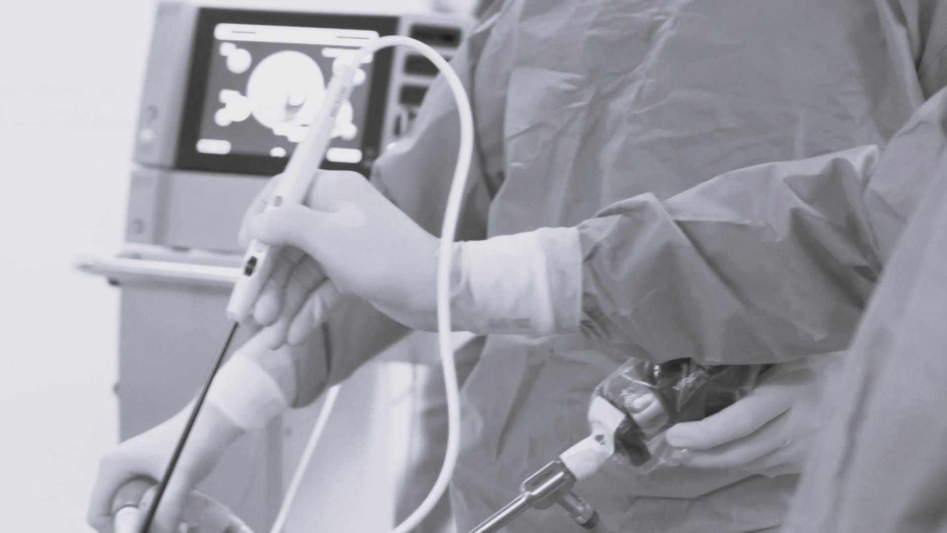 Endometrial ablation using APCapplicator with VIRON X