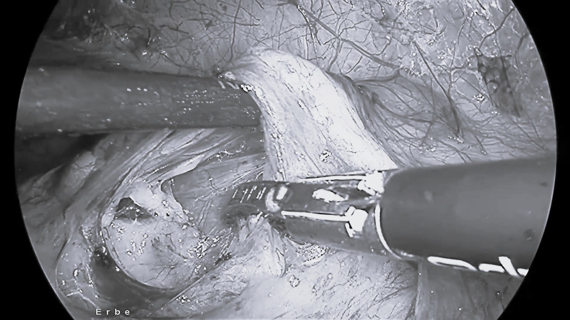 Short-clips-landing-page-TriSect-rap_Donor-Neph_Dissect-and-Seal