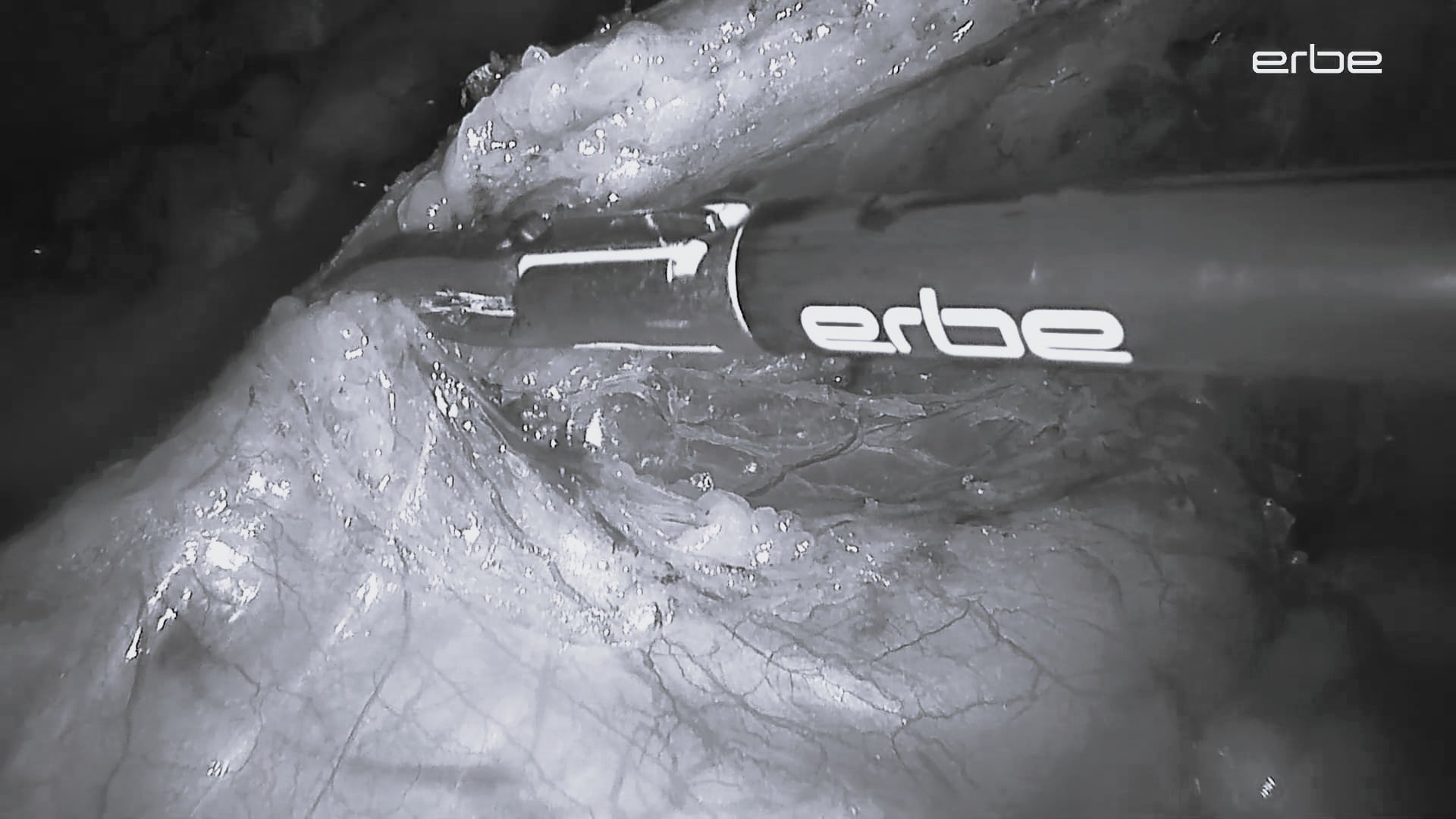 Laparoscopic sigmoidectomy with TriSect rapide® 350 and VIO® 3