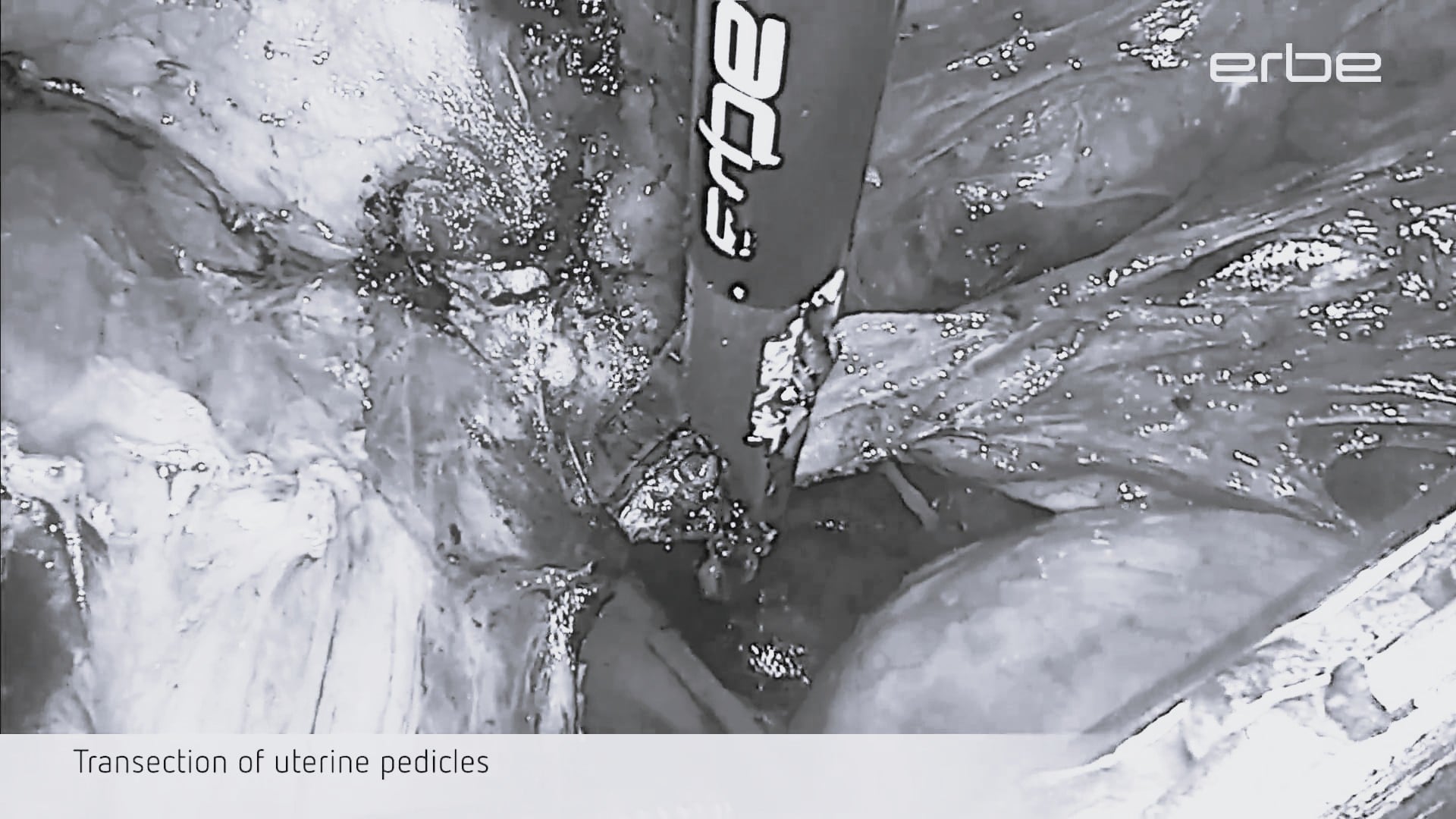 Hysterectomy in case of laparoscopic treatment of deep infiltrating endometriosis (DIE) using TriSect rapide®