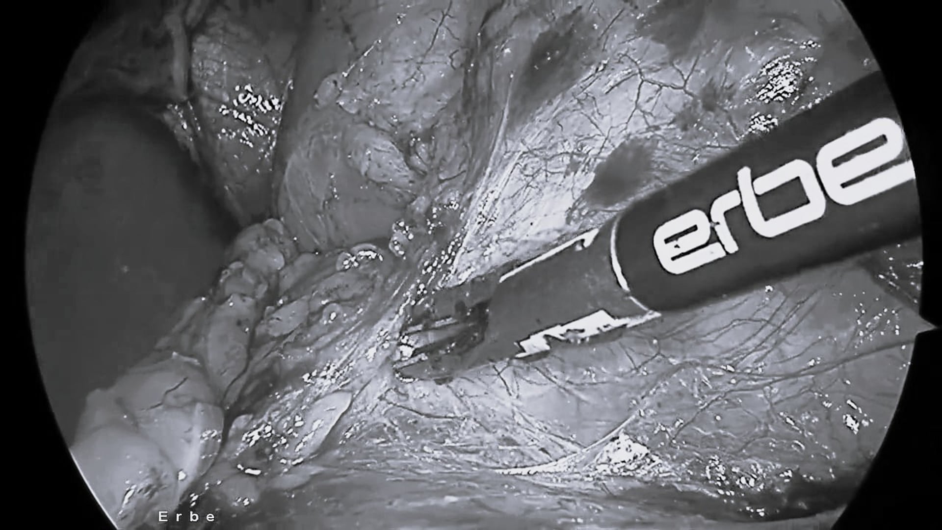Laparoscopic living donor nephrectomy using TriSect rapide® and VIO® 3
