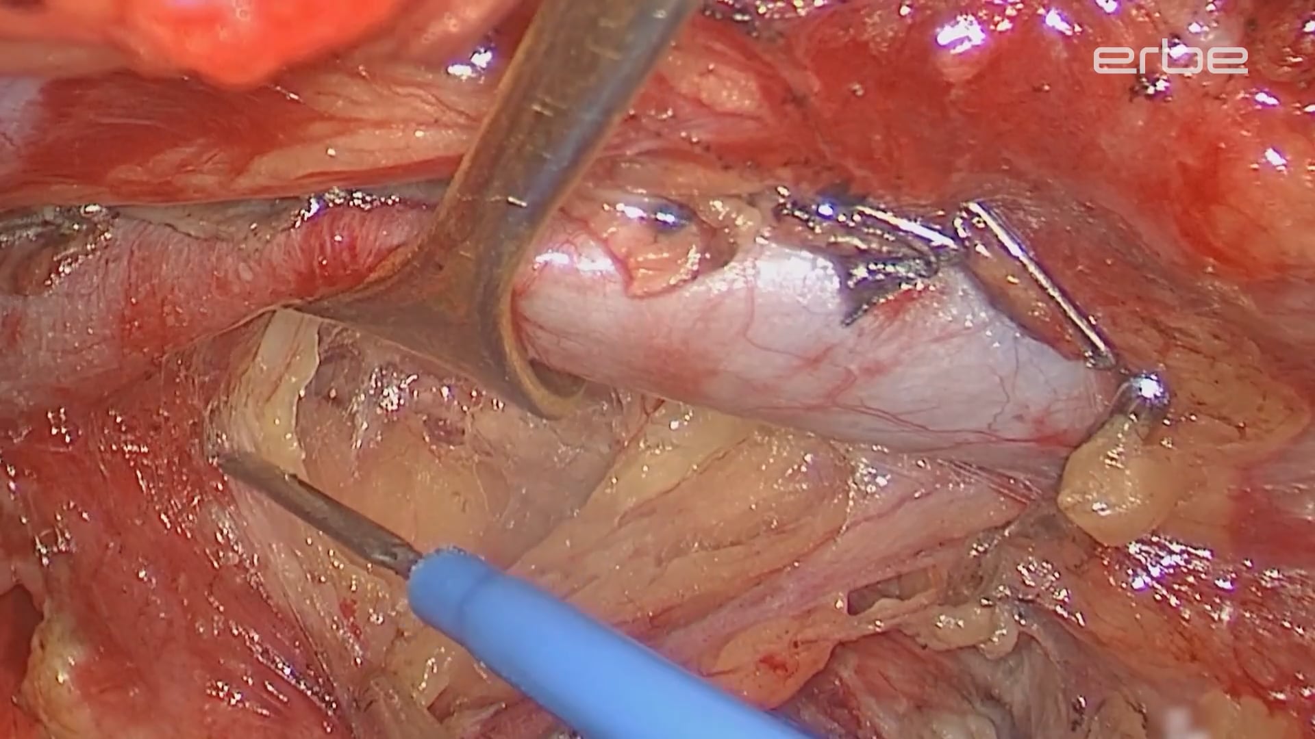 Extended PLND for high risk prostate cancer using VIO® 3 preciseSECT