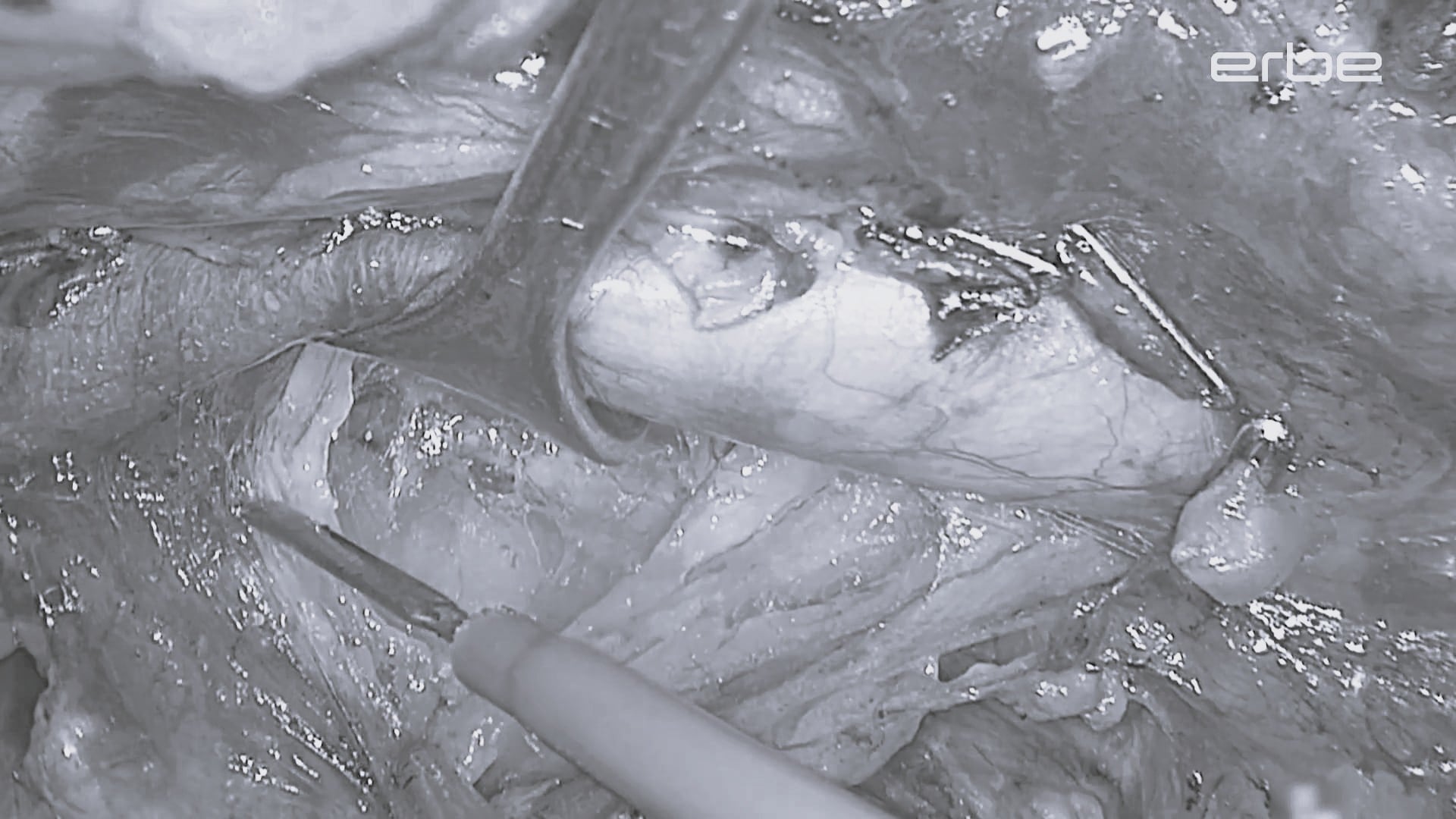 Extended PLND for high risk prostate cancer using VIO® 3 preciseSECT