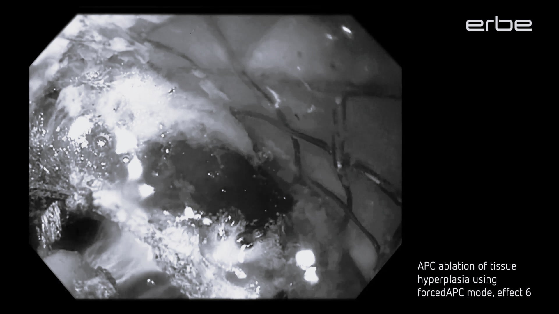 Tissue ablation for metal stent ingrowth with APC 3 using FiAPC probe 2200A in forcedAPC mode