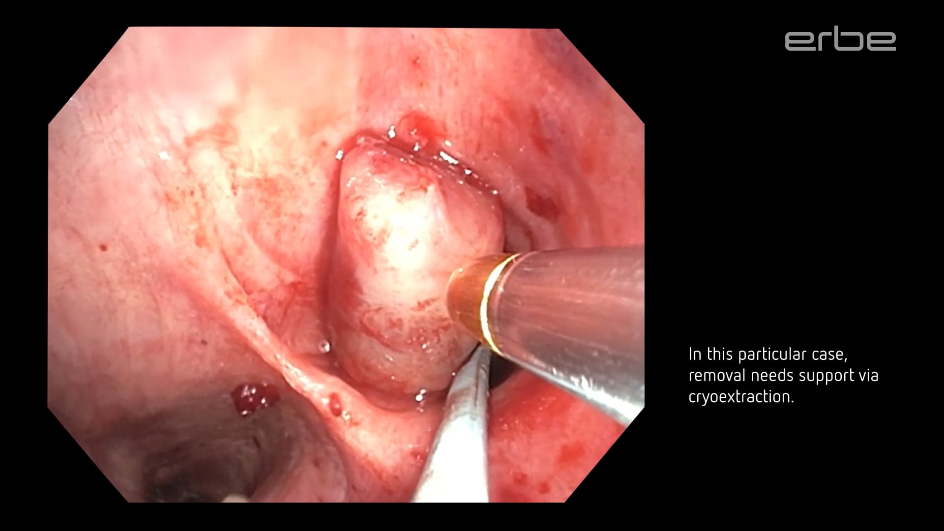 Central airway snaring using endoCUT® Q and cryoextraction of the resected tumor