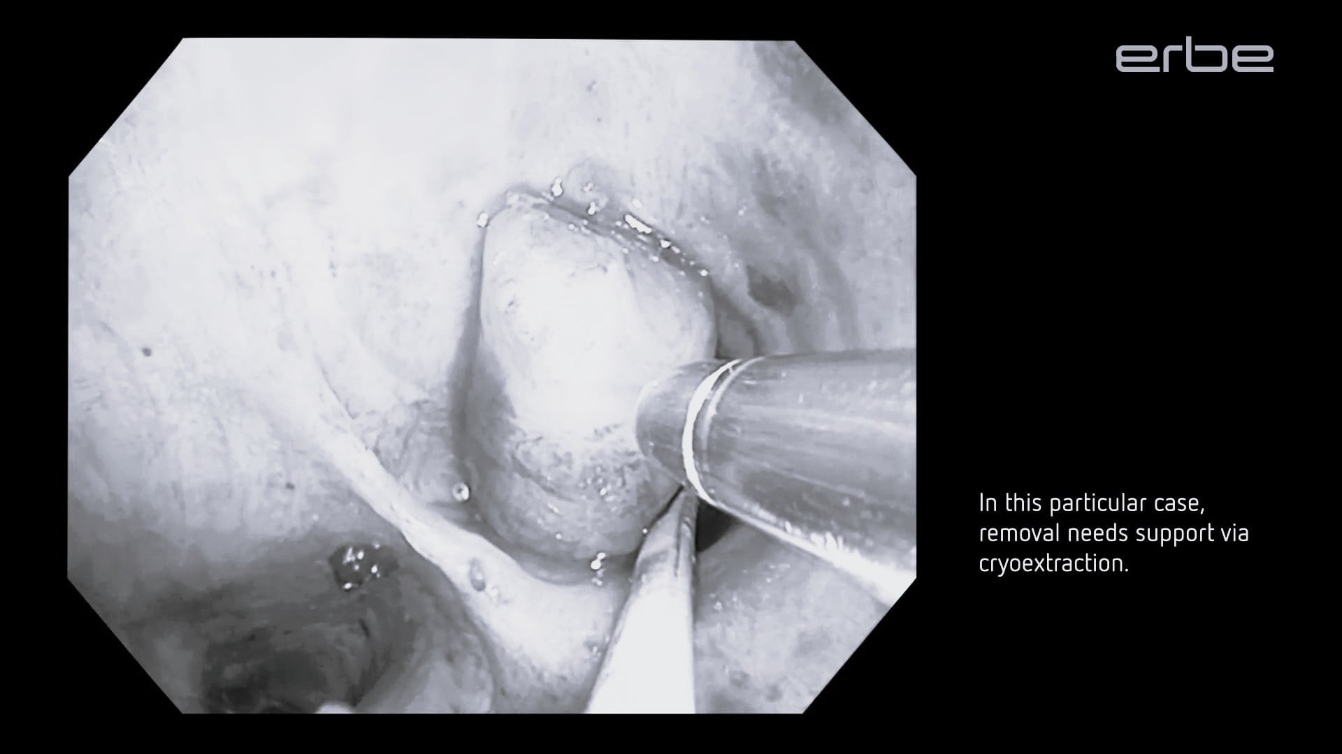 Central airway snaring using endoCUT® Q and cryoextraction of the resected tumor