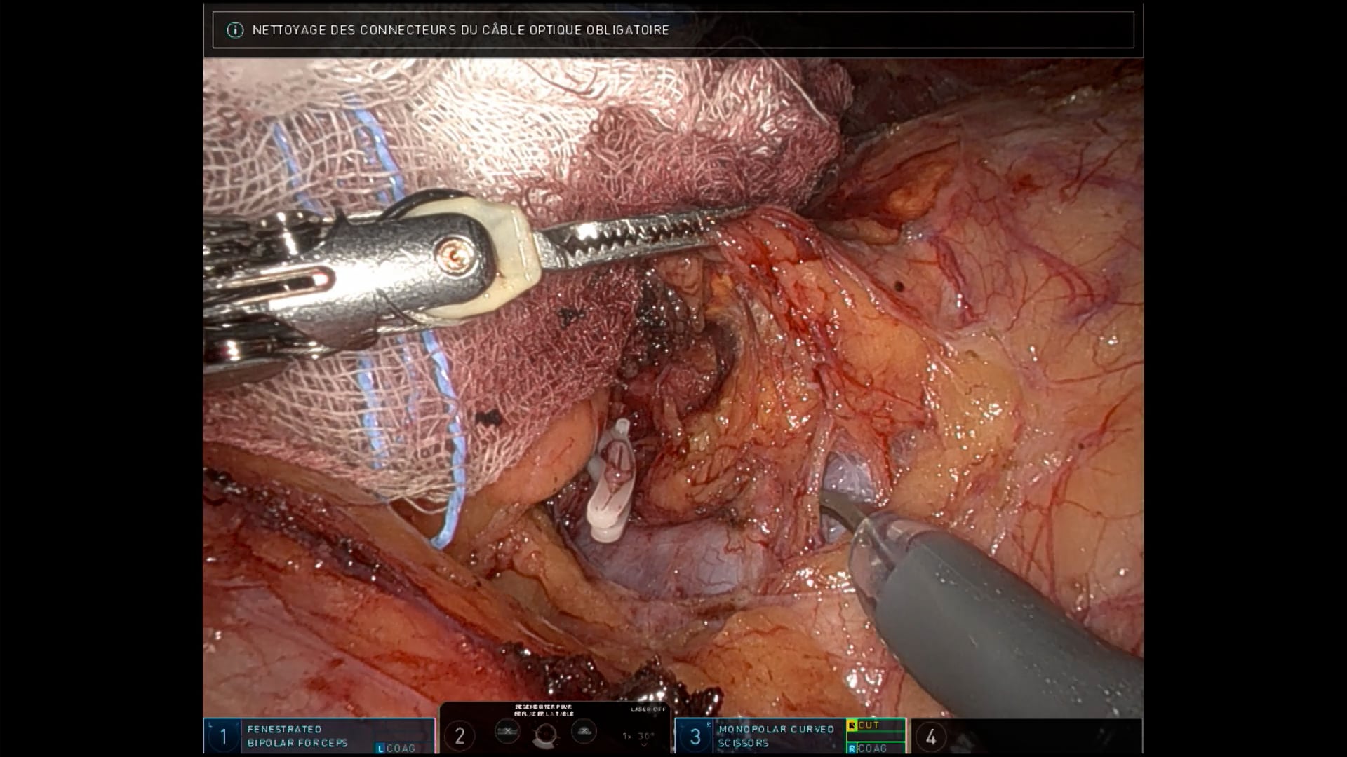 Laparoscopic robot-assisted left adrenalectomy in a male patient with primary aldosteronism
