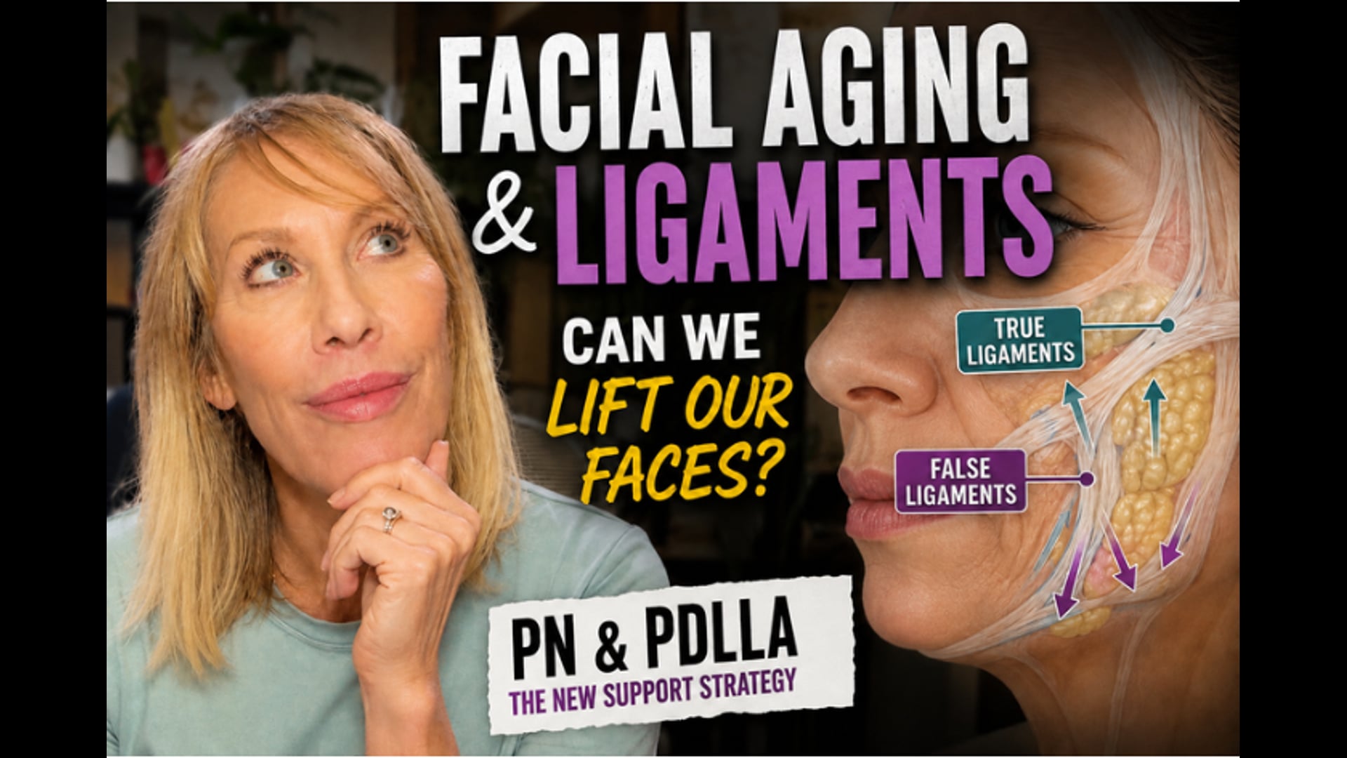 Facial Aging & Retaining Ligaments: Can PN & PDLLA Create Lift?