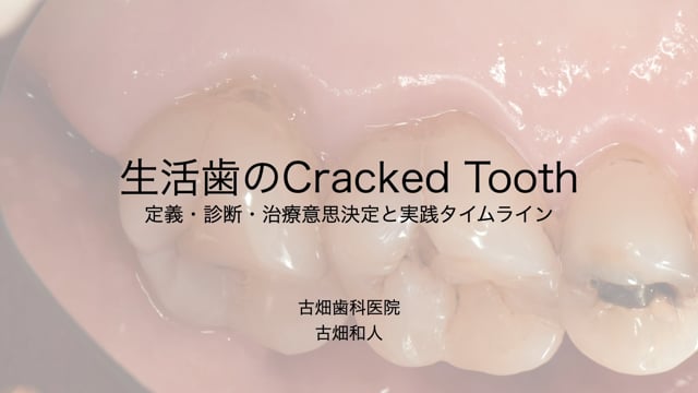 生活歯のCracked Tooth　定義・診断・治療意思決定と実践タイムライン｜古畑 和人先生(Topics)