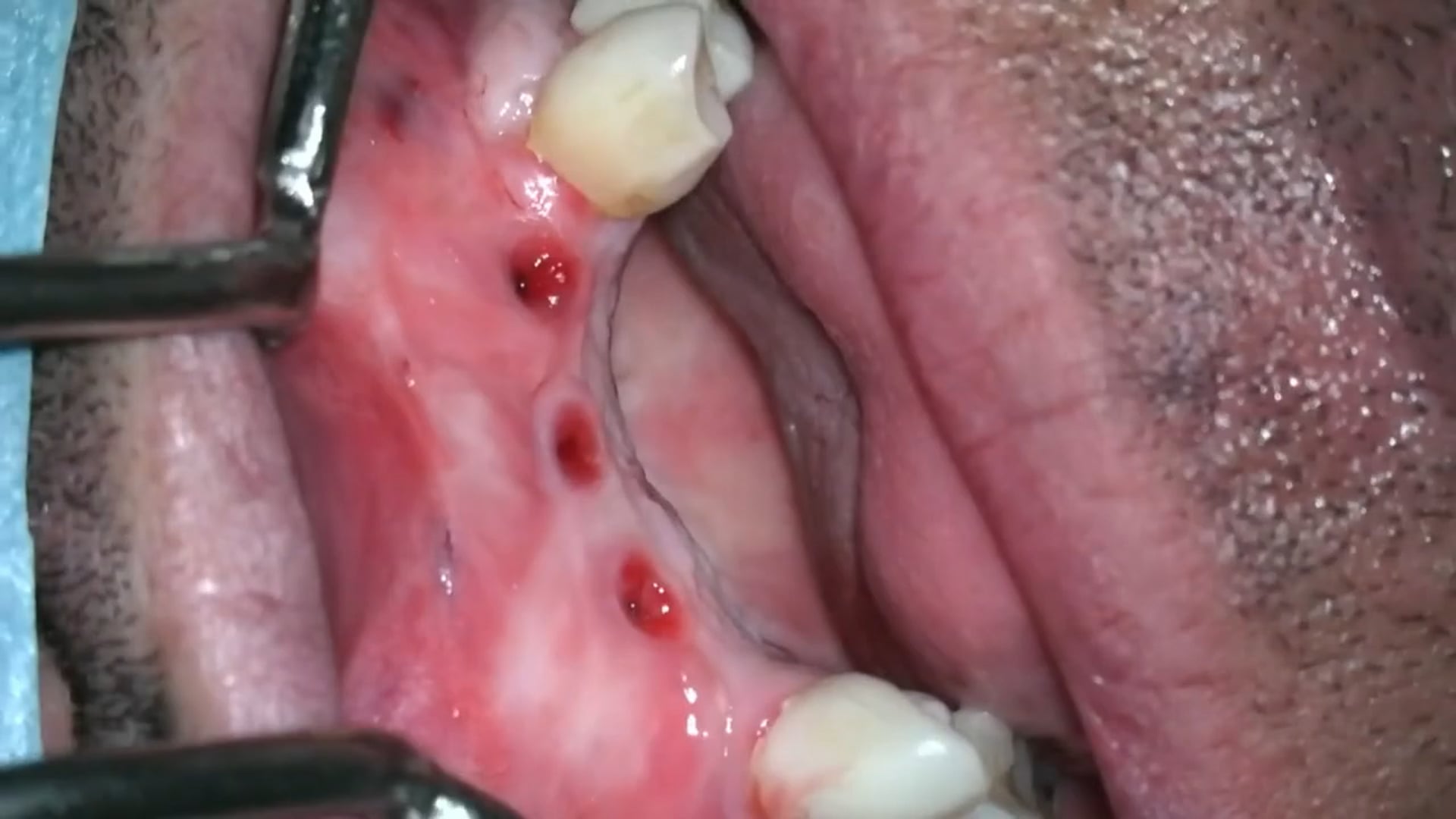 Vestibuloplastia para mejora de tejidos periimplantarios