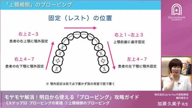 Step5-2 上顎口蓋側のプロービング