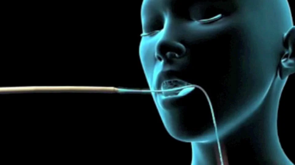Percutaneous Endoscopic Gastrostomy (PEG) Placement