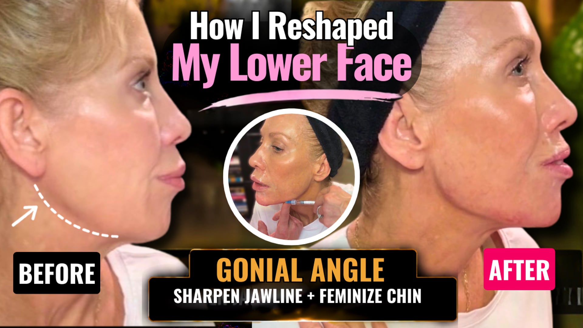 How I Reshaped My Lower Face | Gonial Angle, Jawline & Chin Filler