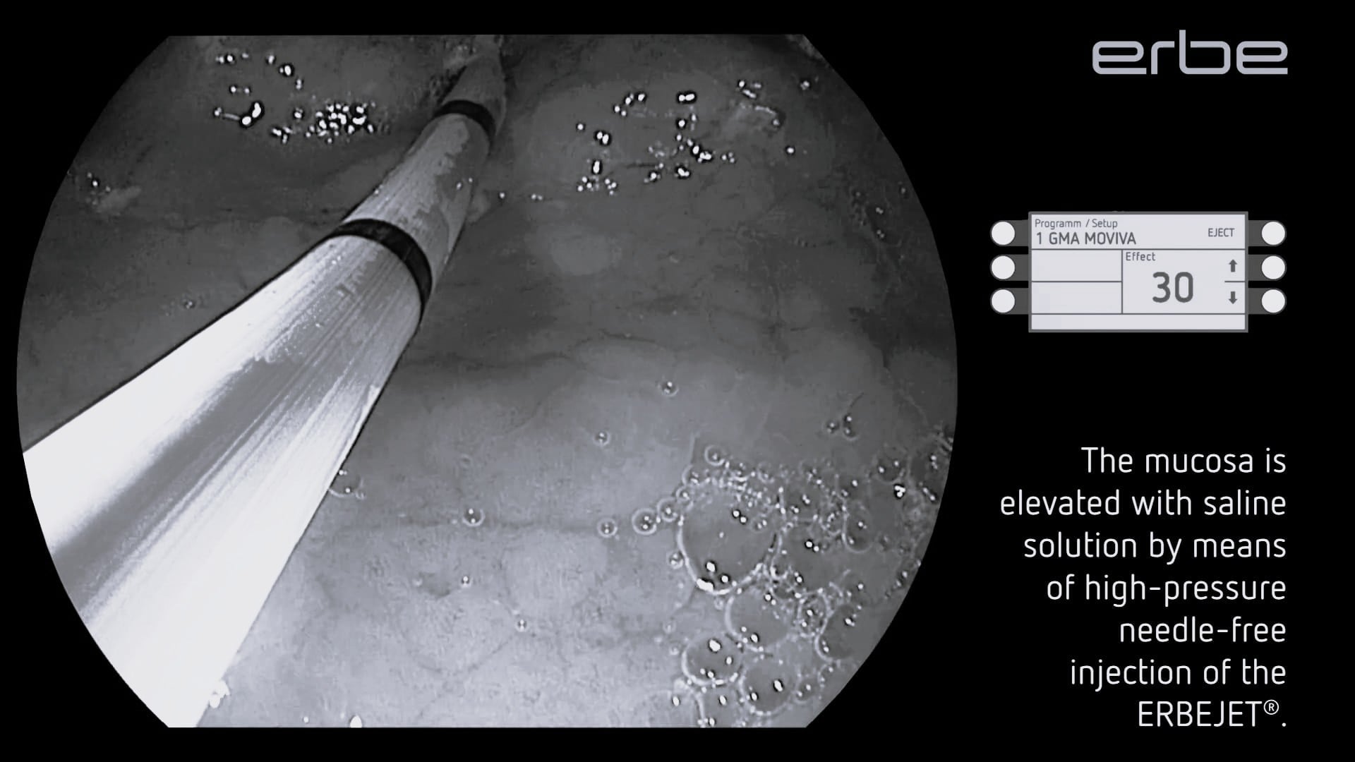 MOVIVA® - Hybrid technology for Gastric Mucosal Ablation (GMA) - Waterjet elevation and APC ablation