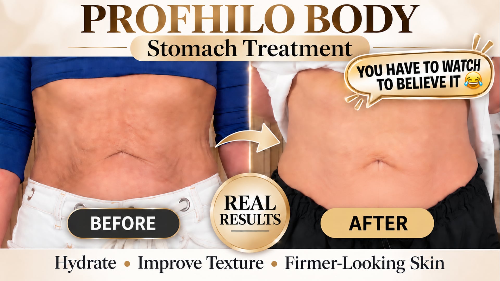 Profhilo Body on My Stomach: These Results Are Hard to Believe!