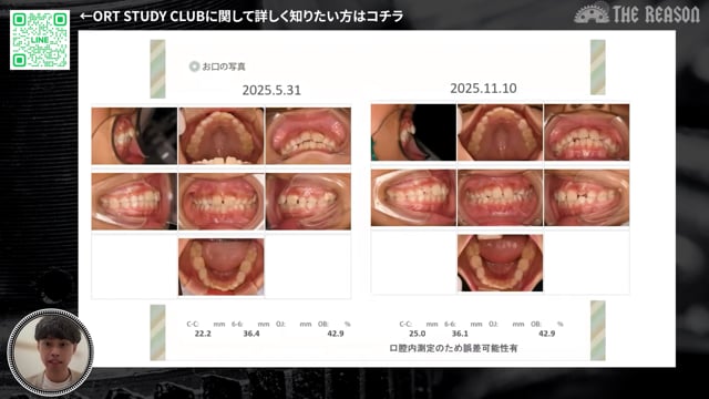 第43回 鼻づまり・いびきを伴う8歳児の小児矯正｜耳鼻科連携と再拡大をどう考えるか