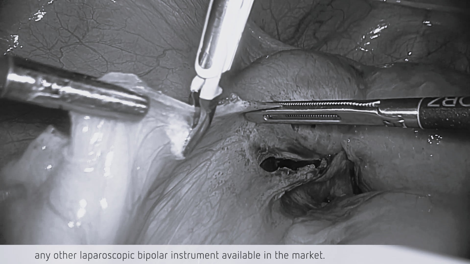 BiClamp® LAP and LAP BiSect in gynecological surgery - a testimonial by Dr. Ma Li, University Hospital Singapore