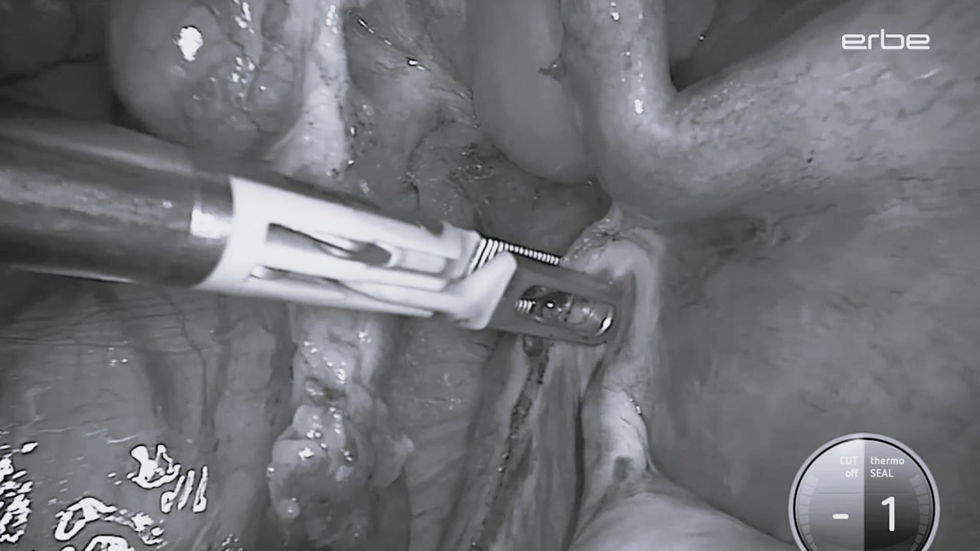 Total laparoscopic hysterectomy (TLH) for adenomyosis with BiClamp® LAP forceps and LAP BiSect Micro
