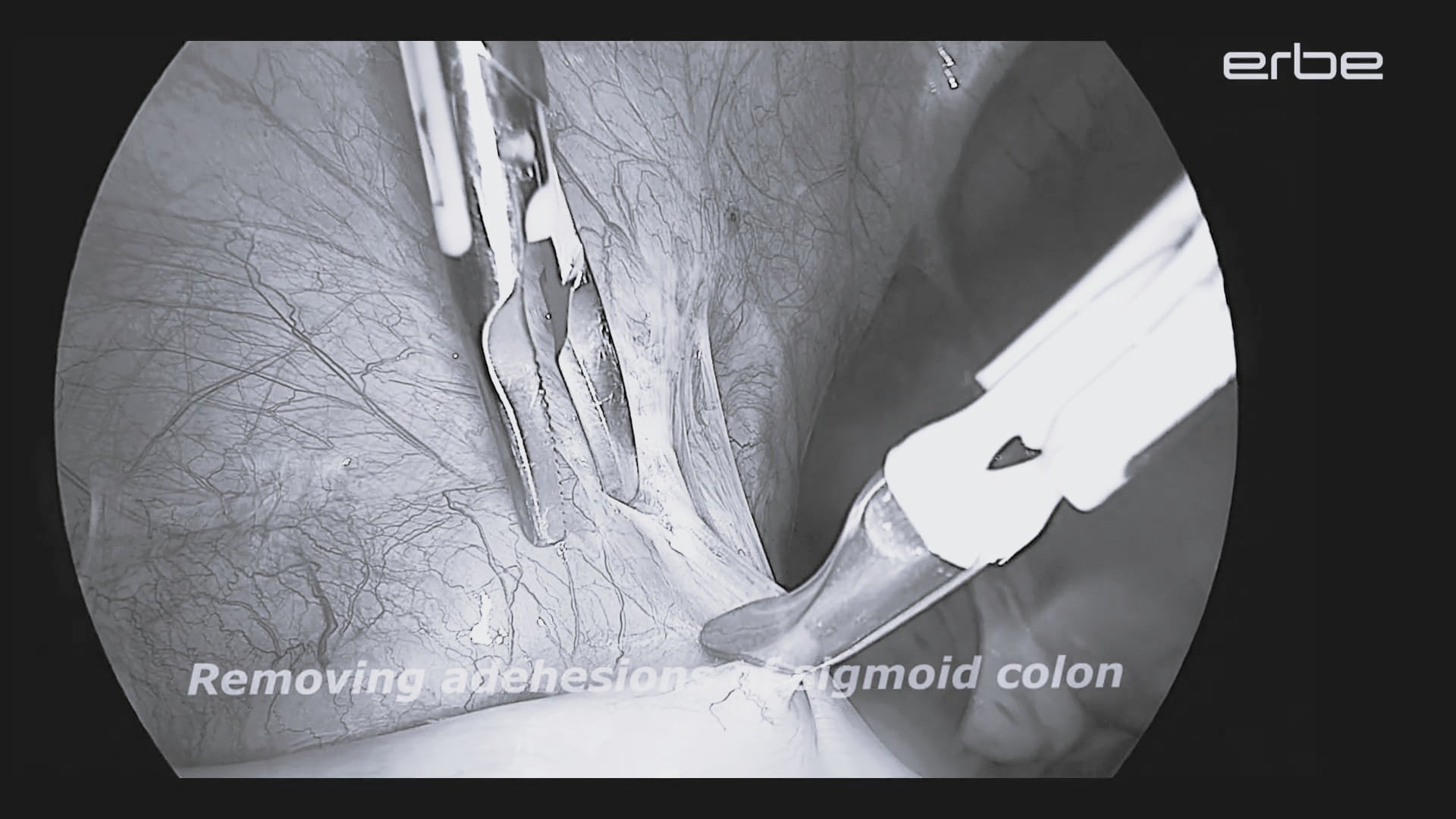 Surgical treatment of deep infiltrating rectocervical endometriosis using Lap BiSect Micro and BiClamp® LAP powered by VIO® 3