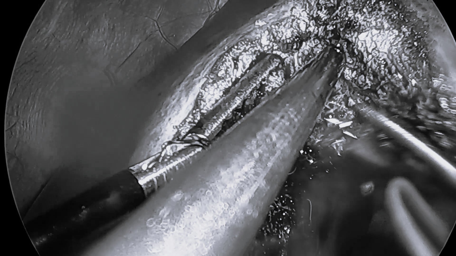 1_Laparoscopic liver resection using ERBEJET 2 and Applicator, straight, 306 mm / video 1 by Dr. Tang, Canada