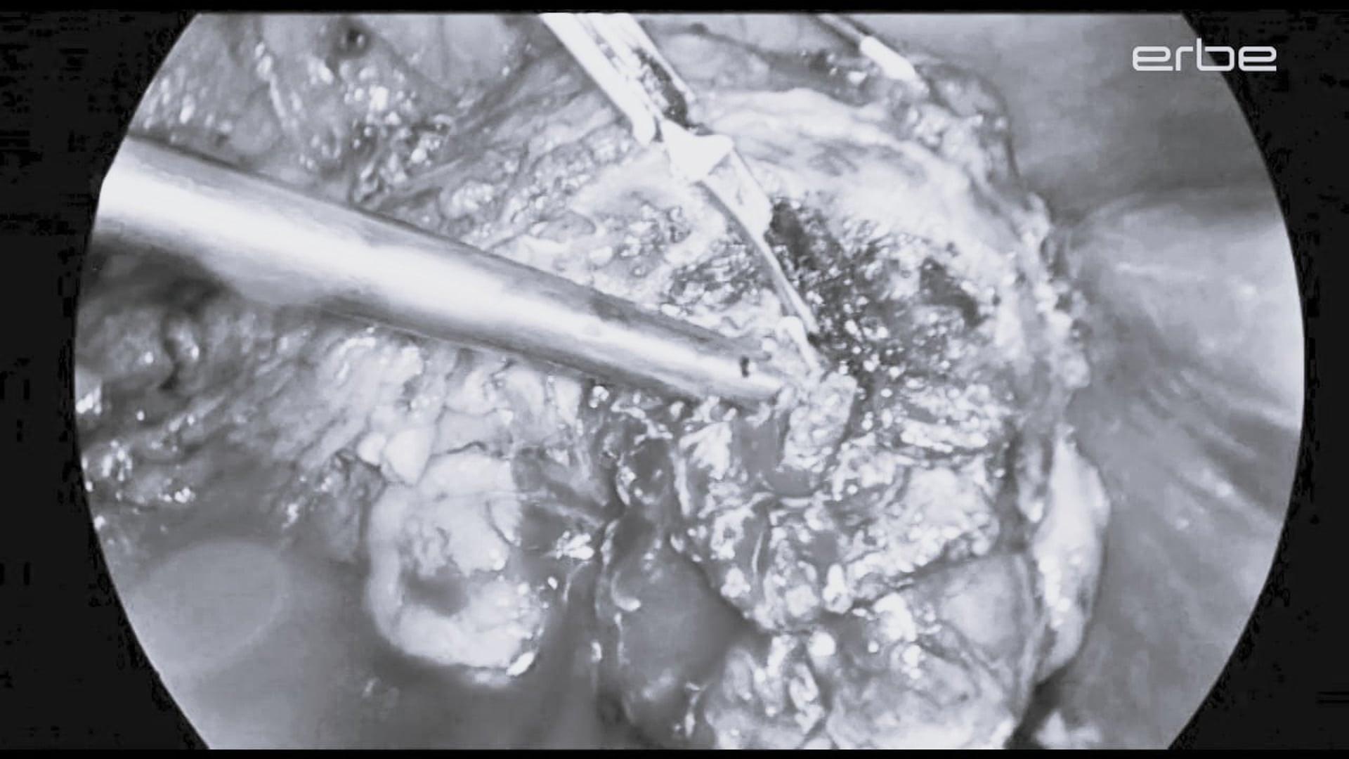 Nephrectomy, partial, laparoscopic, with ERBEJET® 2 and BiClamp®
