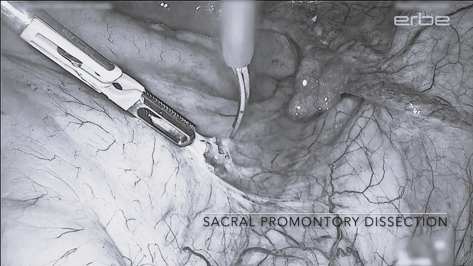 Nerve-sparing laparoscopic sacral colpopexy using VIO® 3 thermoSEAL® and preciseSECT mode