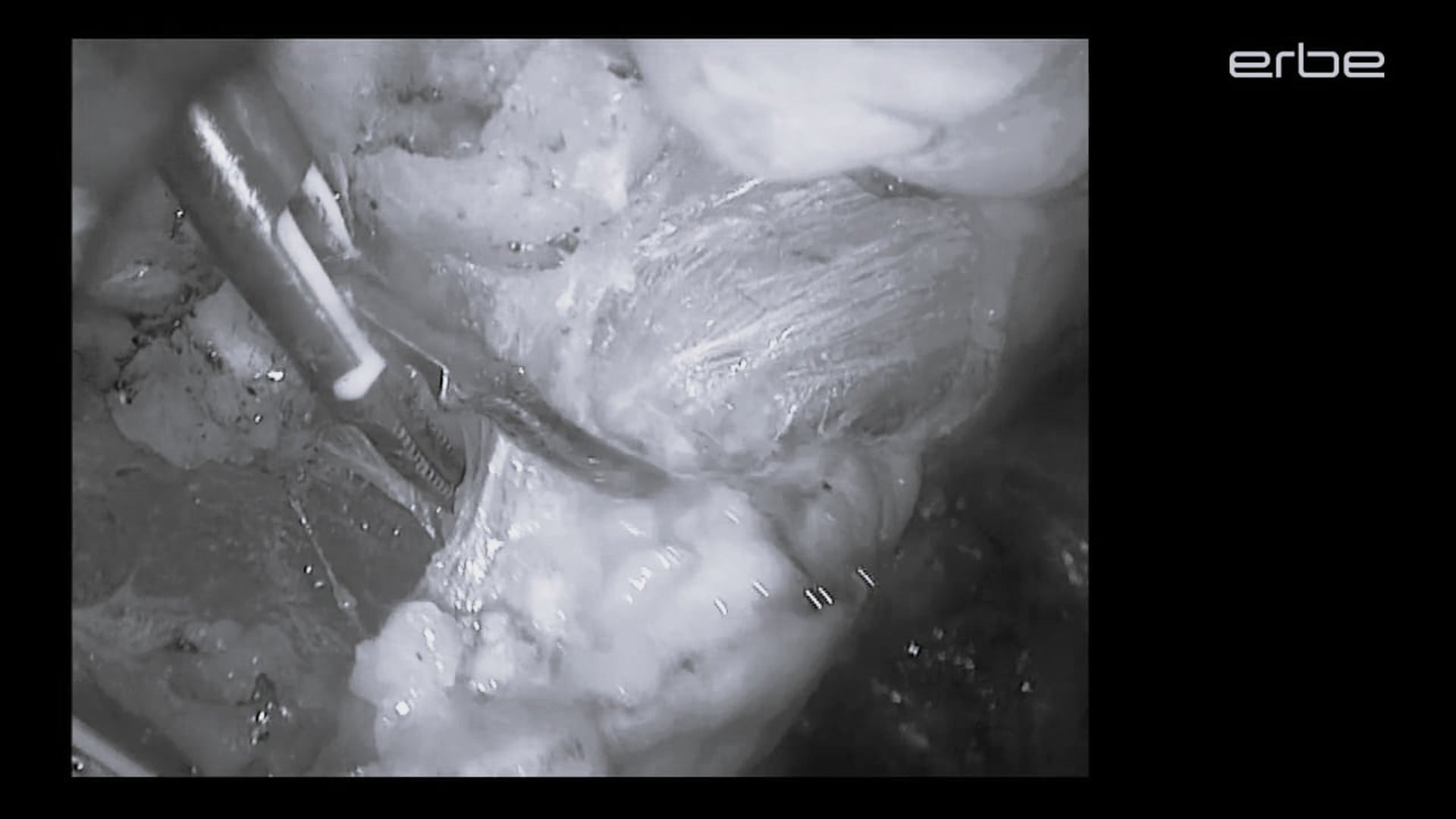 Bladder neck exposure during laparoscopic prostatectomy with LAP BiSect Micro