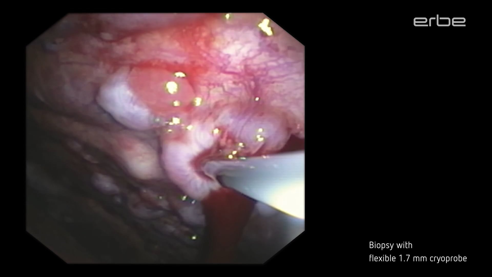 Pleuroscopic cryobiopsies using the flexible 1.7 mm single-use cryoprobe with ERBECRYO® 2