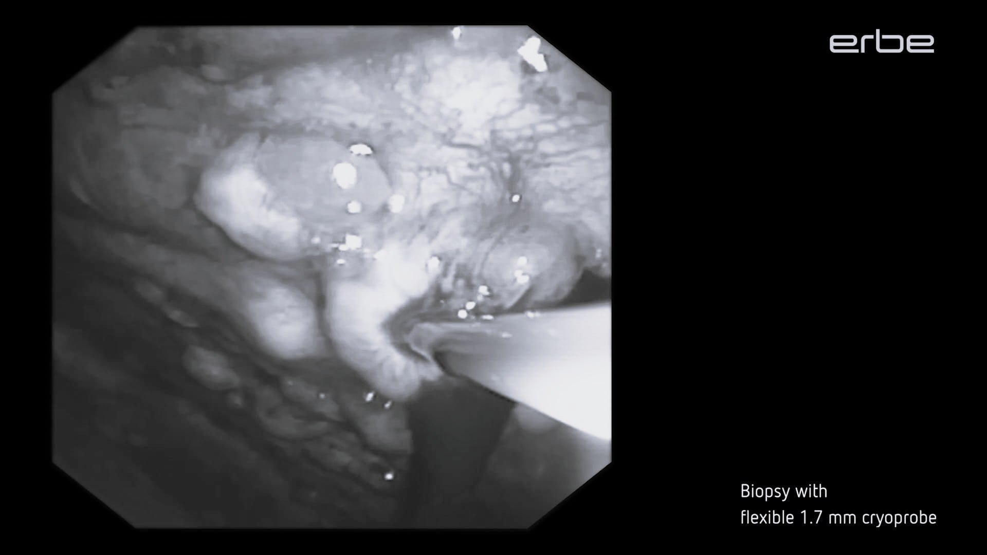 Pleuroscopic cryobiopsies using the flexible 1.7 mm single-use cryoprobe with ERBECRYO® 2