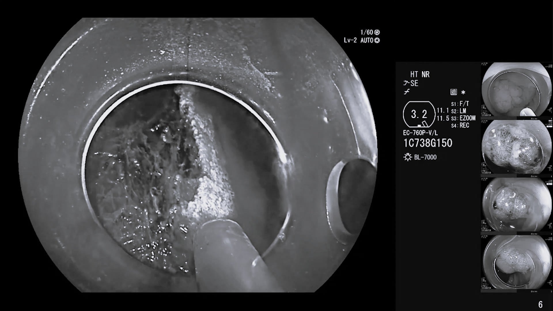VIO®3 preciseAPC with FiAPC® axial