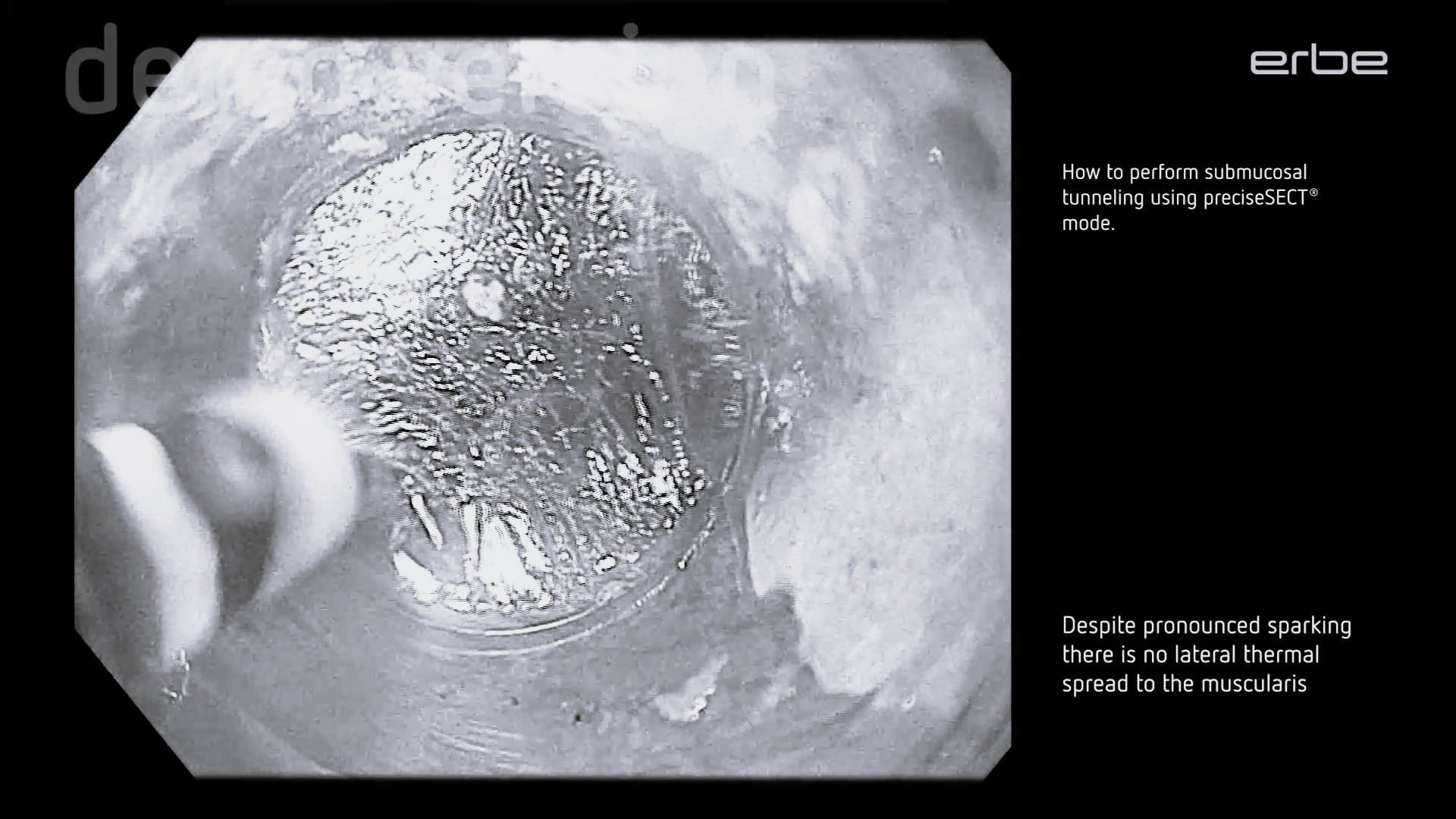 POEM with HybridKnife® using preciseSECT - step by step descriptions on dissection and coagulation