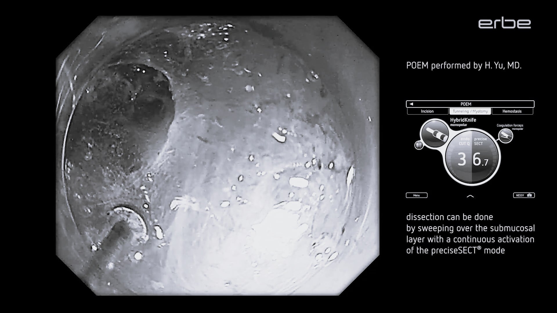 POEM using VIO® 3 preciseSECT mode with HybridKnife® - submucosal tunneling