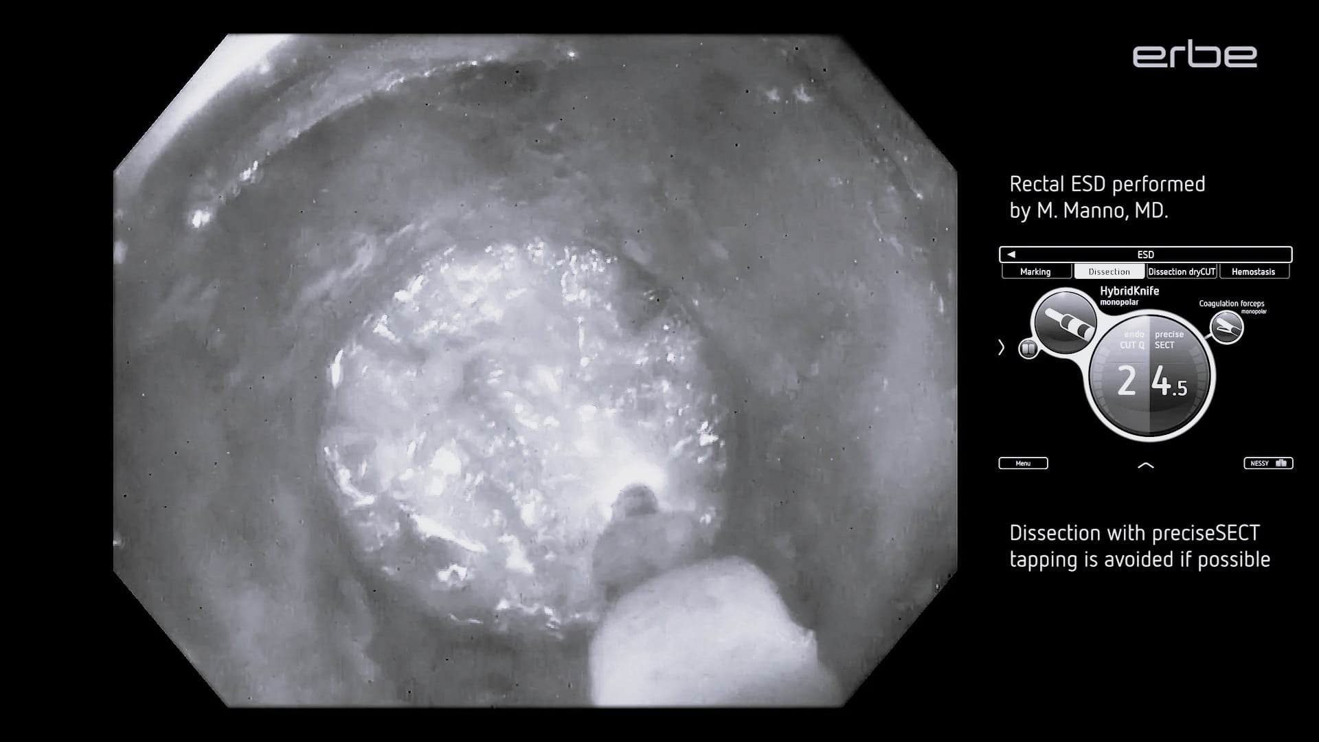 Rectal ESD procedure using VIO® 3 preciseSECT mode with HybridKnife®