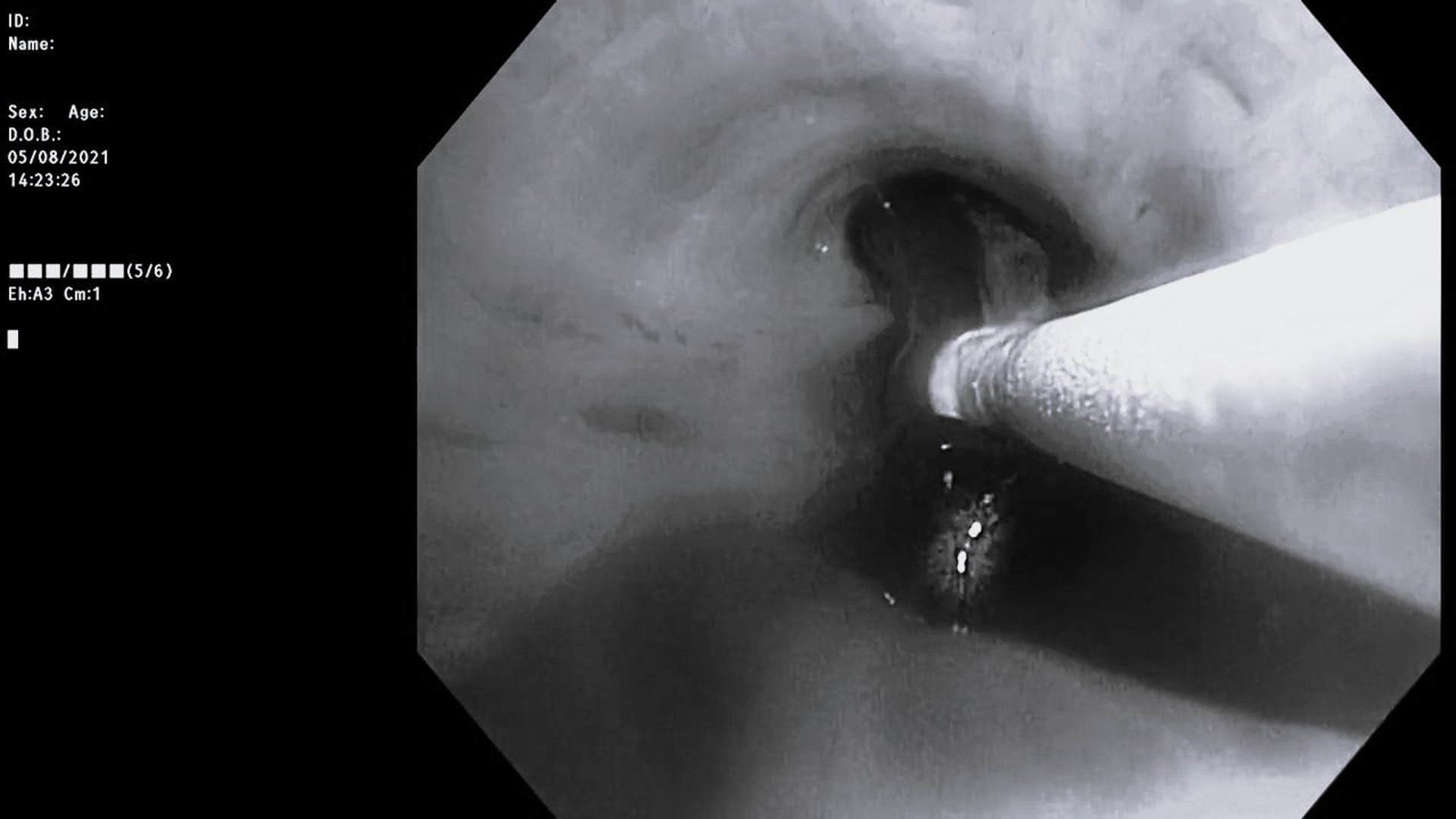 Blood clot cryoextraction of a large central cast in piecemeal-technique using the 1.7mm probe