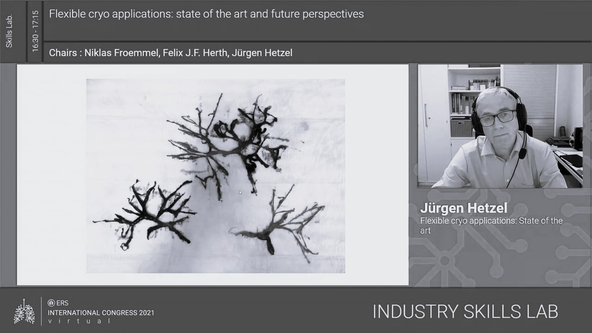 Blood clot cryoextraction – ERS Congress 2021
